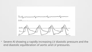 • Severe Al showing a rapidly increasing LV diastolic pressure and the
end diastolic equilibration of aortic and LV pressures.
 