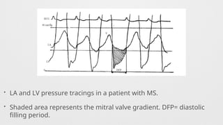 • LA and LV pressure tracings in a patient with MS.
• Shaded area represents the mitral valve gradient. DFP= diastolic
filling period.
 