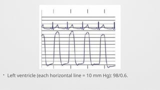 • Left ventricle (each horizontal line = 10 mm Hg): 98/0.6.
 