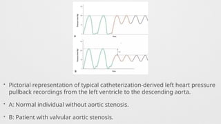 • Pictorial representation of typical catheterization-derived left heart pressure
pullback recordings from the left ventricle to the descending aorta.
• A: Normal individual without aortic stenosis.
• B: Patient with valvular aortic stenosis.
 