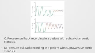 • C: Pressure pullback recording in a patient with subvalvular aortic
stenosis.
• D: Pressure pullback recording in a patient with supravalvular aortic
stenosis.
 