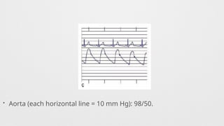 • Aorta (each horizontal line = 10 mm Hg): 98/50.
 