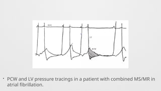 • PCW and LV pressure tracings in a patient with combined MS/MR in
atrial fibrillation.
 