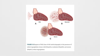 LEFT HEART CATHETERIZATION (LHC) .  PPTX