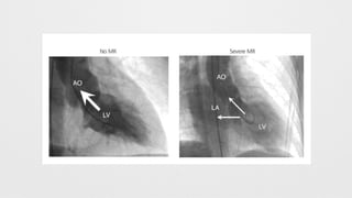 LEFT HEART CATHETERIZATION (LHC) .  PPTX