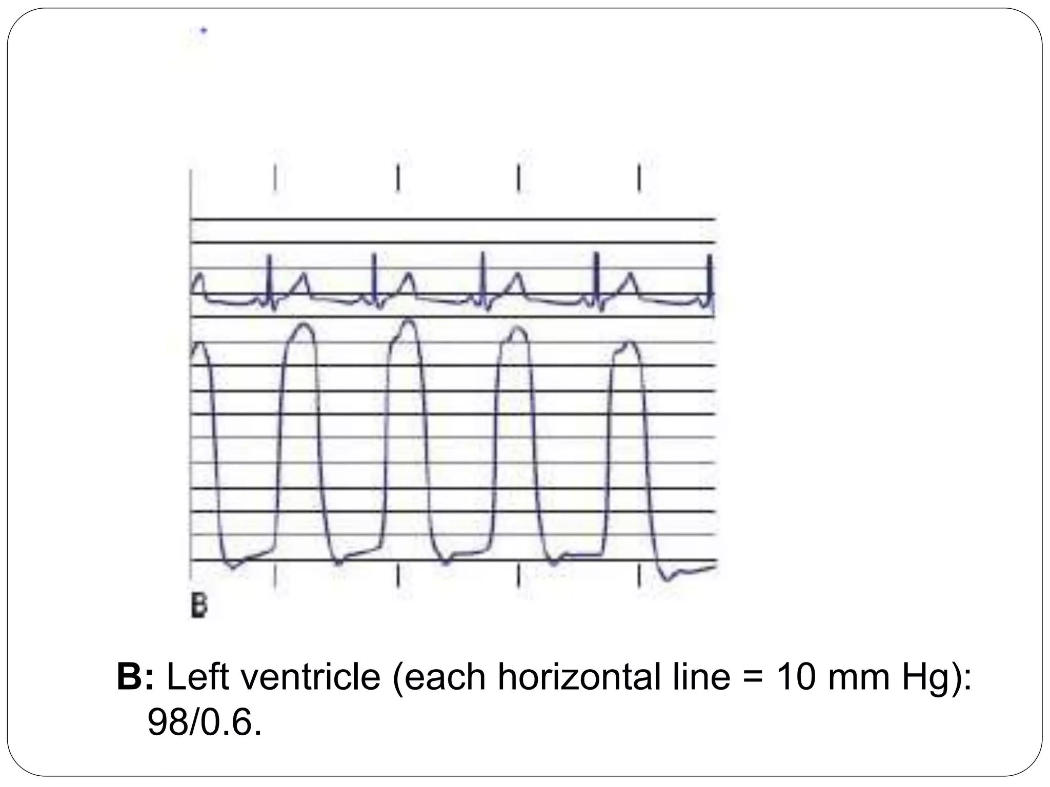 B: Left ventricle (each horizontal line = 10 mm Hg):
98/0.6.
 