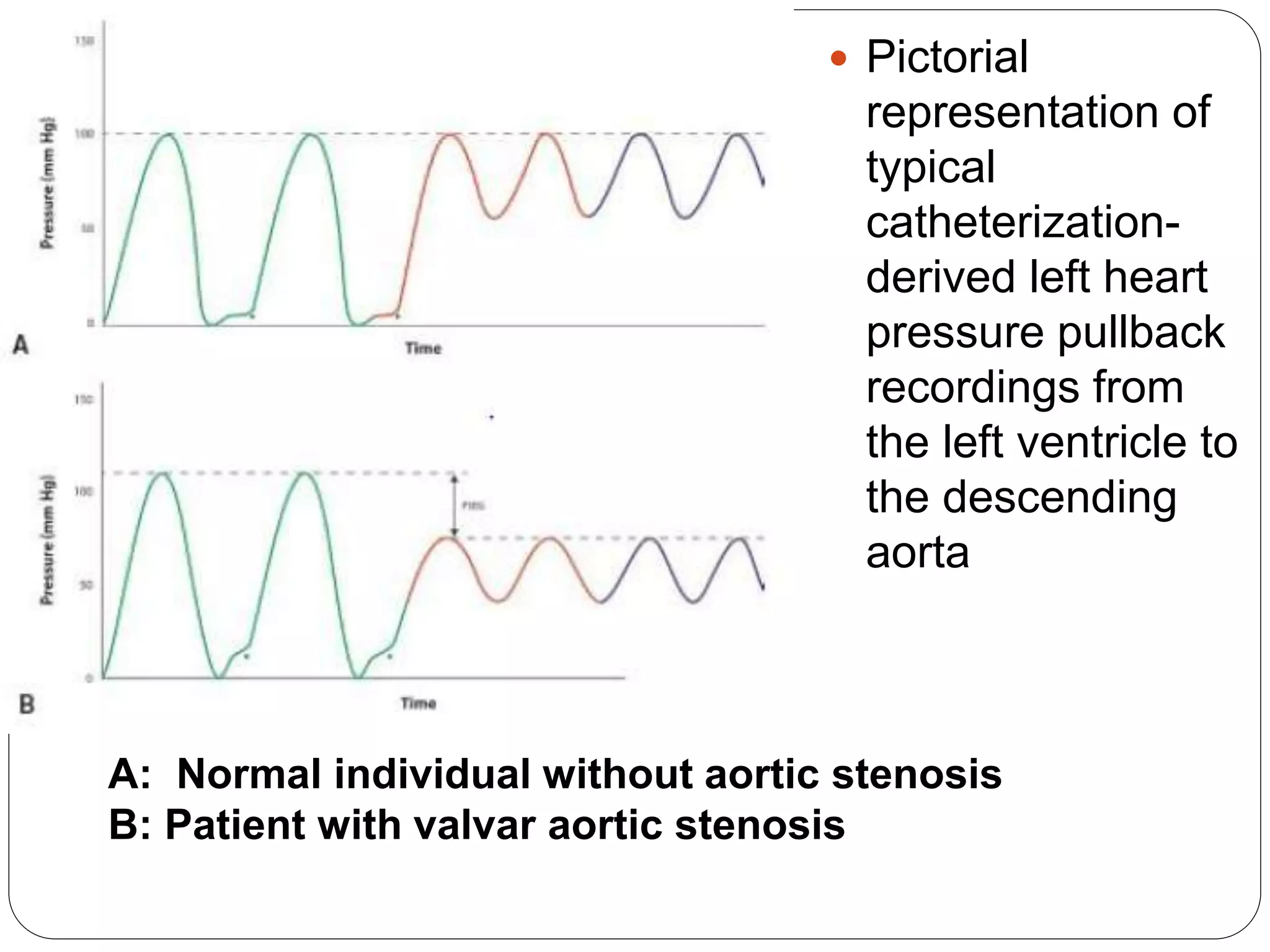  Pictorial
representation of
typical
catheterization-
derived left heart
pressure pullback
recordings from
the left ventricle to
the descending
aorta
A: Normal individual without aortic stenosis
B: Patient with valvar aortic stenosis
 