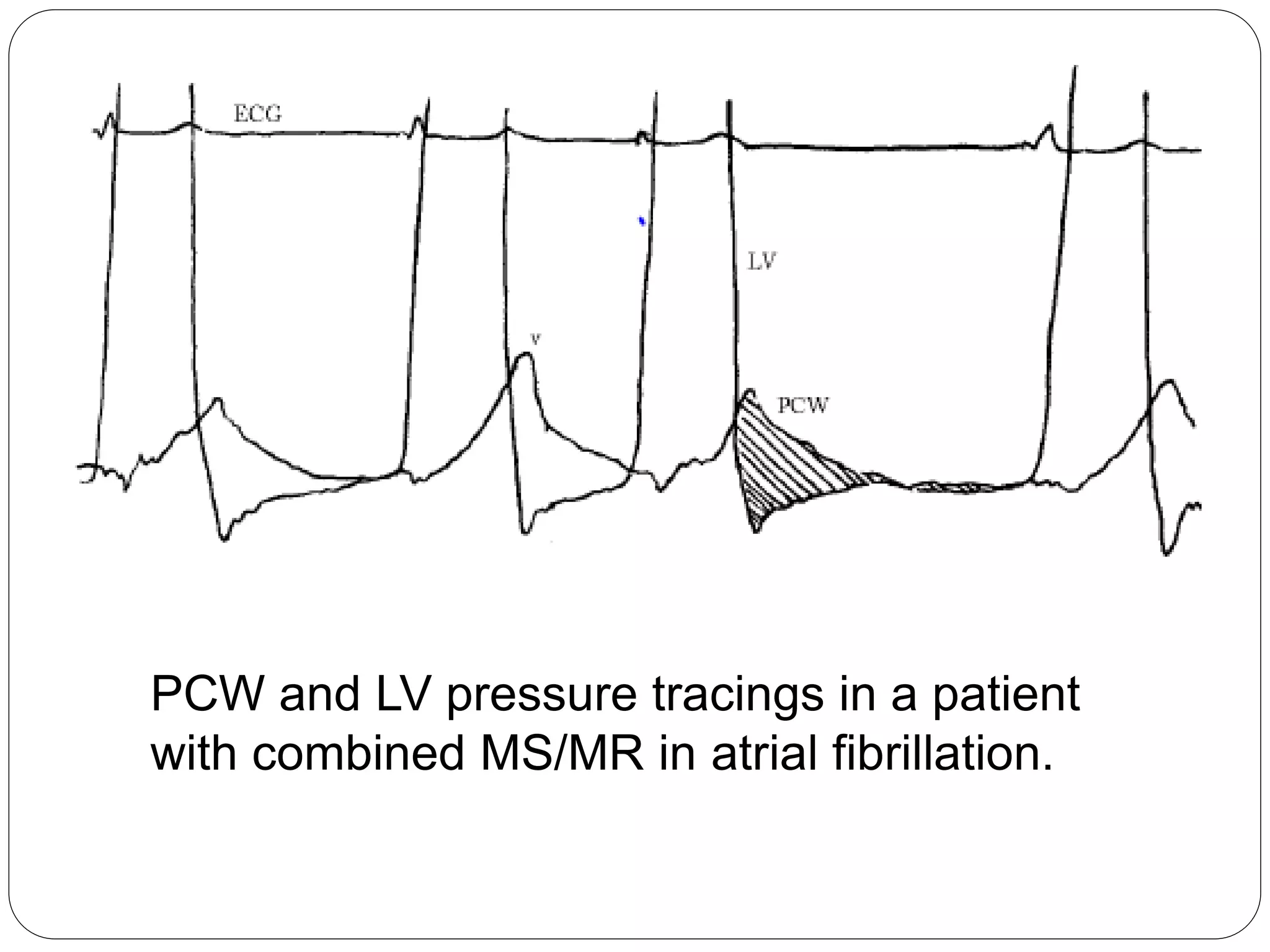 PCW and LV pressure tracings in a patient
with combined MS/MR in atrial fibrillation.
 