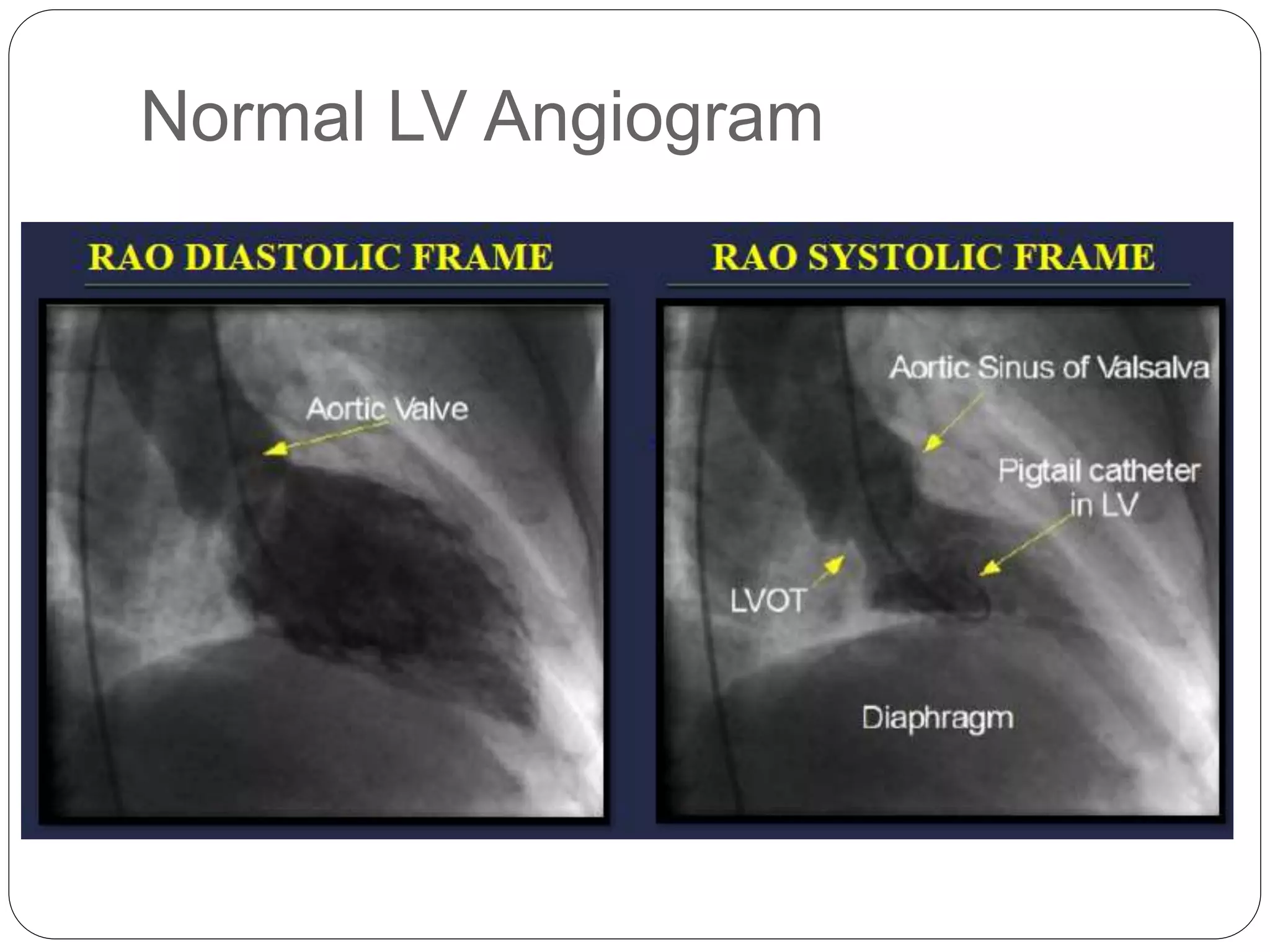 Normal LV Angiogram
 