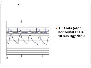 Left heart catheterization dr. nazmun ara | PPTX