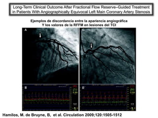 Long-Term Clinical Outcome After Fractional Flow Reserve–Guided Treatment
     in Patients With Angiographically Equivocal Left Main Coronary Artery Stenosis

               Ejemplos de discordancia entre la apariencia angiográfica
                     Y los valores de la RFFM en lesiones del TCI




Hamilos, M. de Bruyne, B, et al. Circulation 2009;120:1505-1512
 