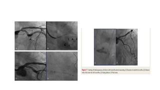 Left main stenting