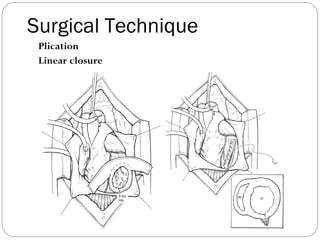 Surgical Technique
Plication
Linear closure
 