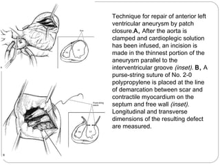 Technique for repair of anterior left
ventricular aneurysm by patch
closure.A, After the aorta is
clamped and cardioplegic solution
has been infused, an incision is
made in the thinnest portion of the
aneurysm parallel to the
interventricular groove (inset). B, A
purse-string suture of No. 2-0
polypropylene is placed at the line
of demarcation between scar and
contractile myocardium on the
septum and free wall (inset).
Longitudinal and transverse
dimensions of the resulting defect
are measured. 
 