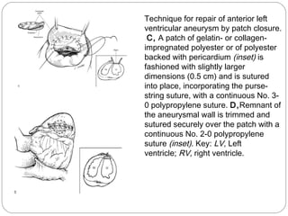 Technique for repair of anterior left
ventricular aneurysm by patch closure.
 C, A patch of gelatin- or collagen-
impregnated polyester or of polyester
backed with pericardium (inset) is
fashioned with slightly larger
dimensions (0.5 cm) and is sutured
into place, incorporating the purse-
string suture, with a continuous No. 3-
0 polypropylene suture. D,Remnant of
the aneurysmal wall is trimmed and
sutured securely over the patch with a
continuous No. 2-0 polypropylene
suture (inset). Key: LV, Left
ventricle; RV, right ventricle.
 