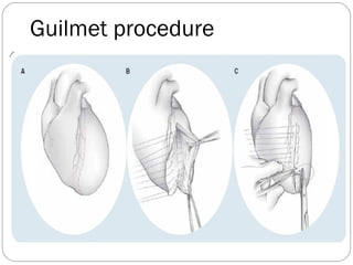 Guilmet procedure
 