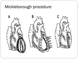 Mickleborough procedure
 