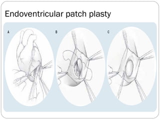 Endoventricular patch plasty
 