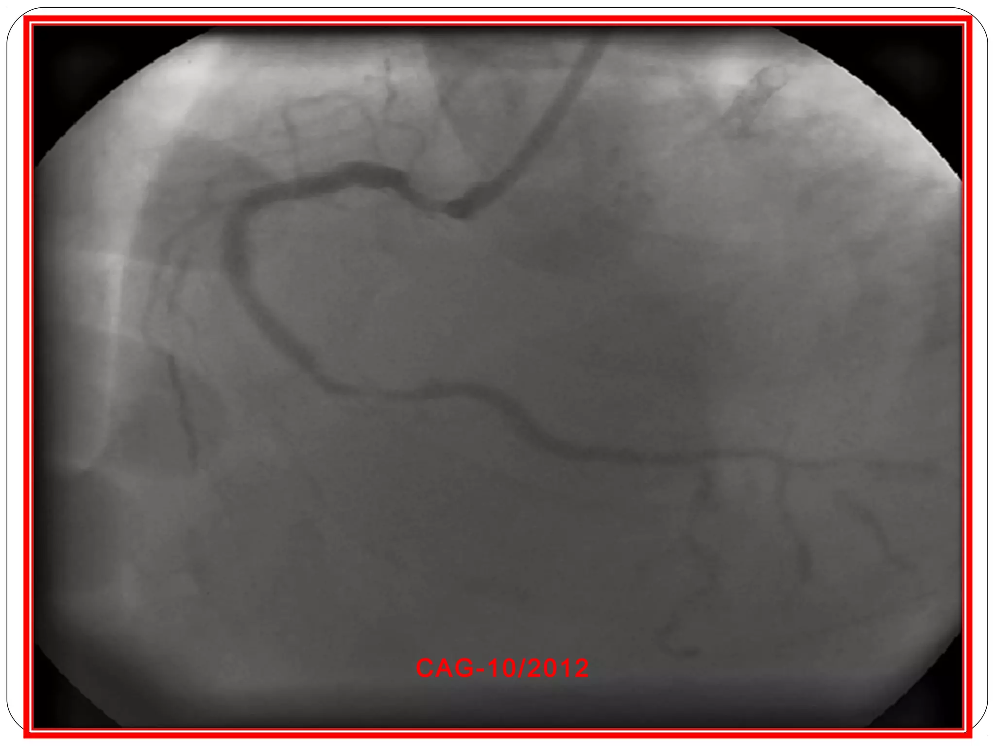 Left ventricular aneurysm | PPT