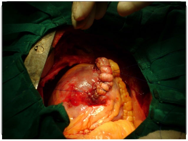Left ventricular aneurysm
