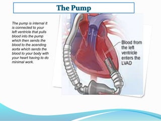 The pump is internal It
is connected to your
left ventricle that pulls
blood into the pump
which then sends the
blood to the acending
aorta which sends the
blood to your body with
your heart having to do
minimal work.
 