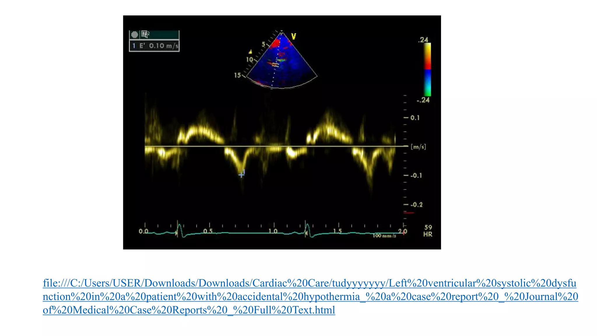 Left Ventricular Diastolic Dysfunction In Echocardiography Pptx