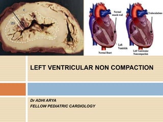Dr ADHI ARYA
FELLOW PEDIATRIC CARDIOLOGY
LEFT VENTRICULAR NON COMPACTION
 