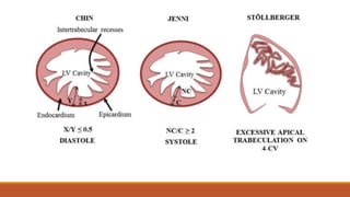 Left ventricular noncompaction | PPTX