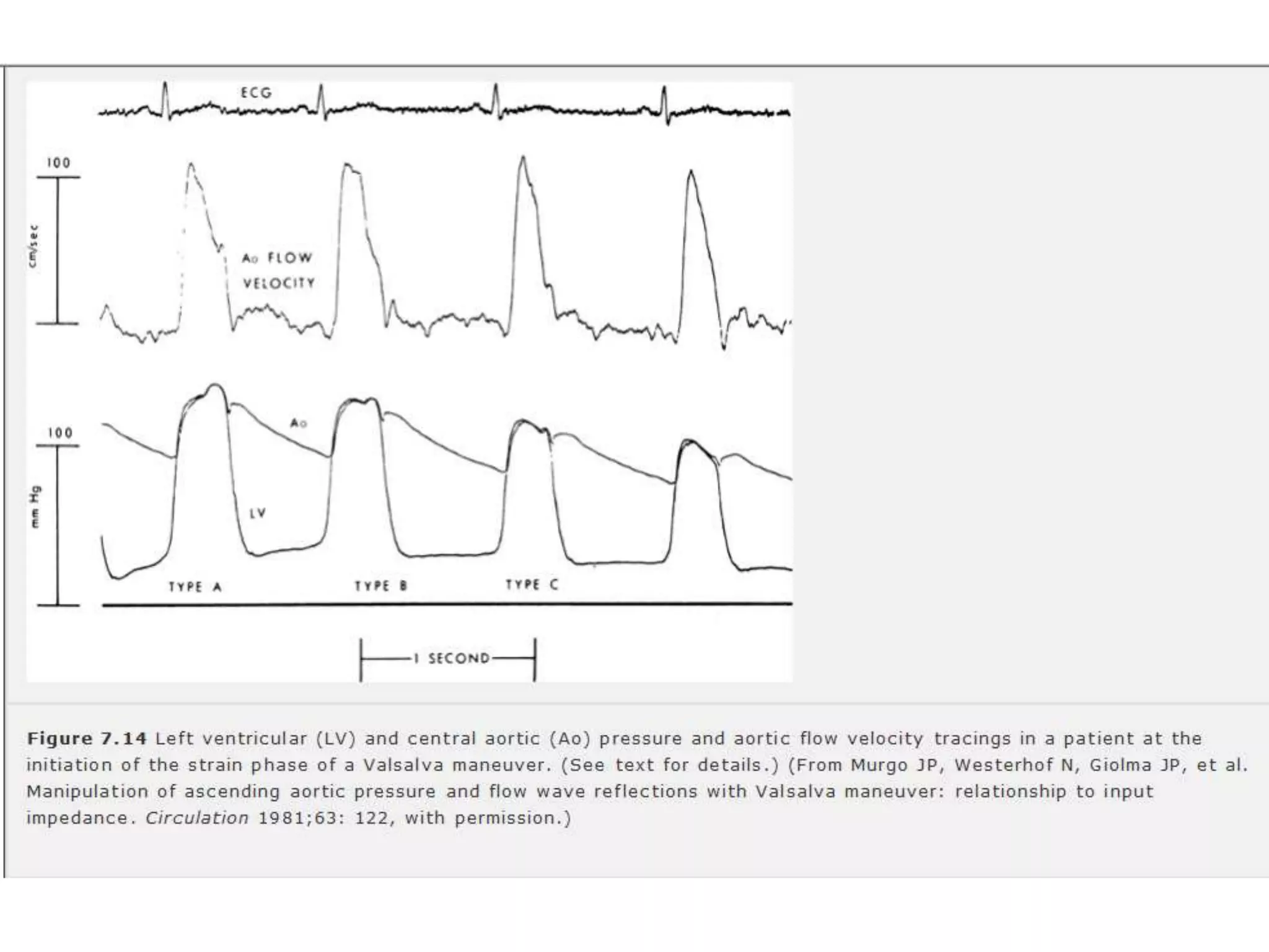 Left ventricular pressure tracings | PPTX