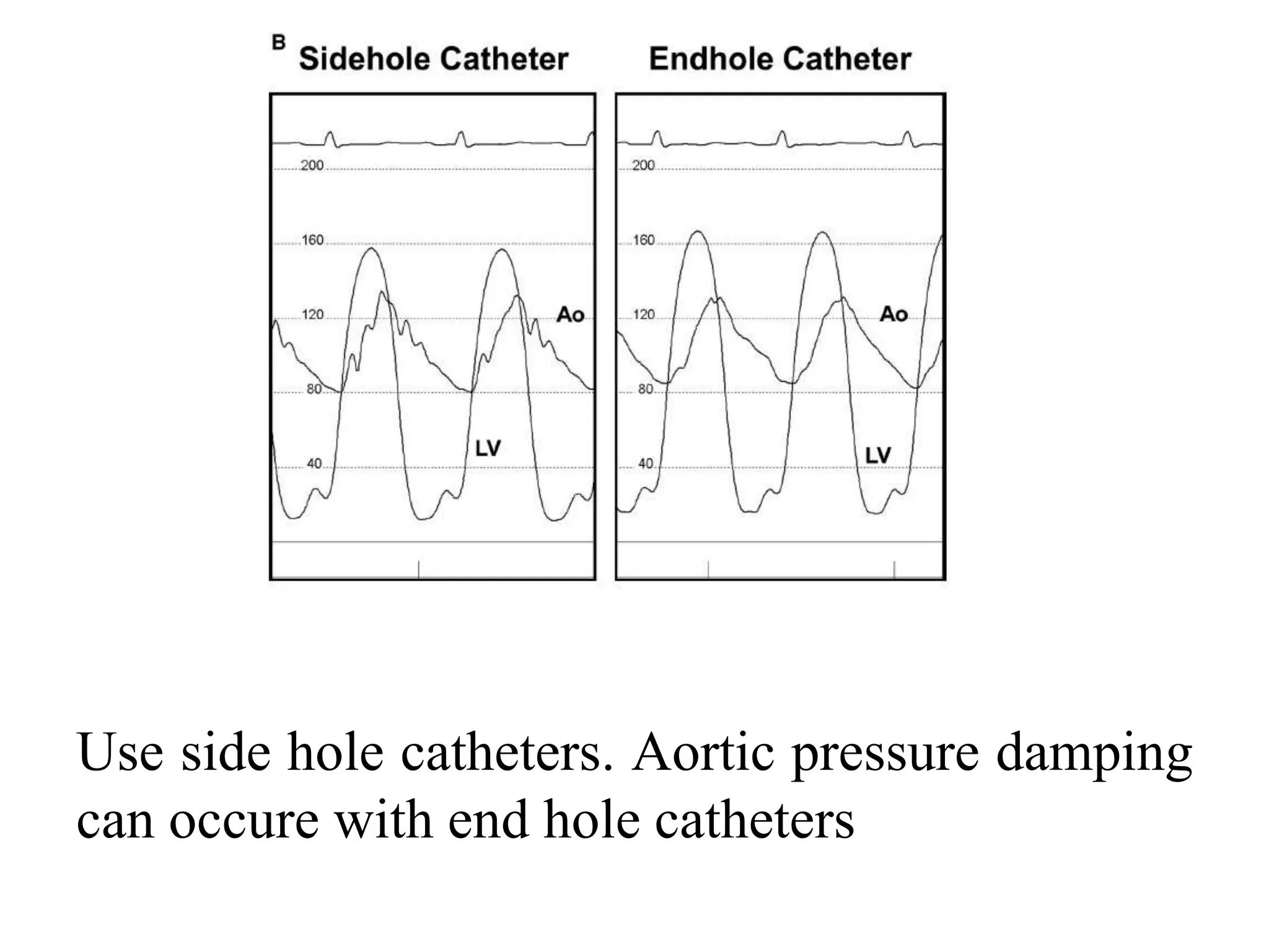 Left ventricular pressure tracings | PPTX