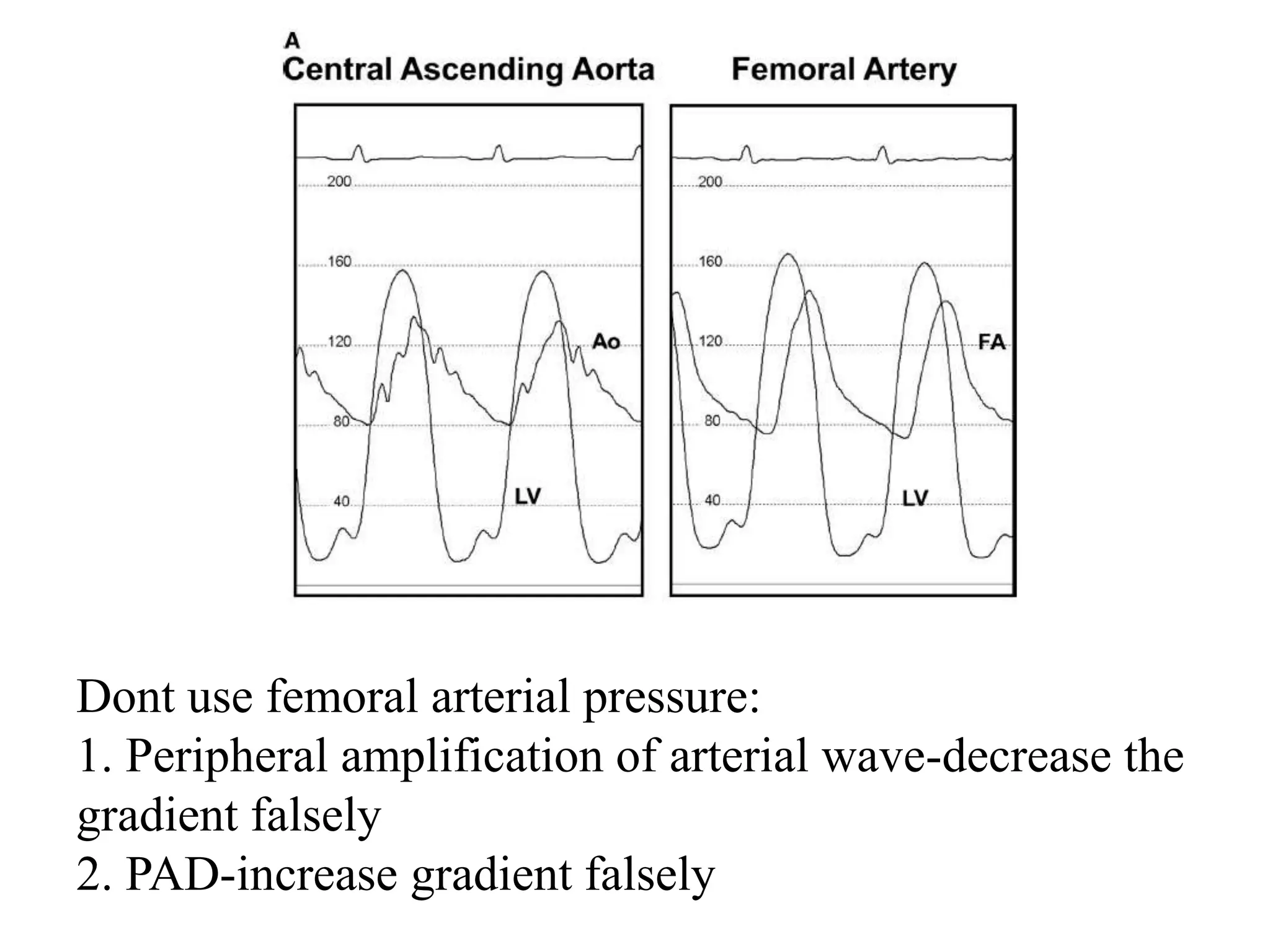 Left ventricular pressure tracings | PPTX