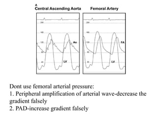 Dont use femoral arterial pressure:
1. Peripheral amplification of arterial wave-decrease the
gradient falsely
2. PAD-increase gradient falsely
 