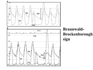 Braunwald-
Brockenborough
sign
 