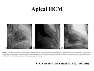 Apical HCM
C.-C. Chen et al: Clin. Cardiol. 34, 4, 233–238 (2011)
 