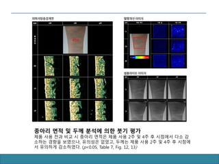 종아리 면적 및 두께 분석에 의한 붓기 평가
제품 사용 전과 비교 시 종아리 면적은 제품 사용 2주 및 4주 후 시점에서 다소 감
소하는 경향을 보였으나, 유의성은 없었고, 두께는 제품 사용 2주 및 4주 후 시점에
서 유의하게 감소하였다. (p<0.05, Table 7, Fig. 12, 13)
 