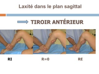 Laxité dans le plan sagittal 
TIROIR ANTÉRIEUR 
RI R=0 RE 
 