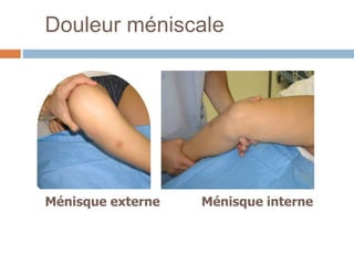 Douleur méniscale 
Ménisque externe Ménisque interne 
 