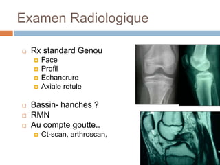 Examen Radiologique 
 Rx standard Genou 
 Face 
 Profil 
 Echancrure 
 Axiale rotule 
 Bassin- hanches ? 
 RMN 
 Au compte goutte.. 
 Ct-scan, arthroscan, 
 