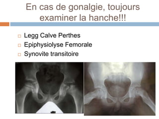En cas de gonalgie, toujours 
examiner la hanche!!! 
 Legg Calve Perthes 
 Epiphysiolyse Femorale 
 Synovite transitoire 
 