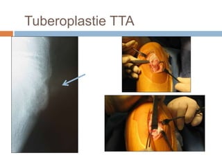 Tuberoplastie TTA 
 
