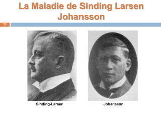 La Maladie de Sinding Larsen 
Johansson 
23 
 