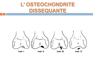L’ OSTEOCHONDRITE 
DISSEQUANTE 
25 
 