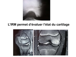 L’IRM permet d’évaluer l’état du cartilage 
 