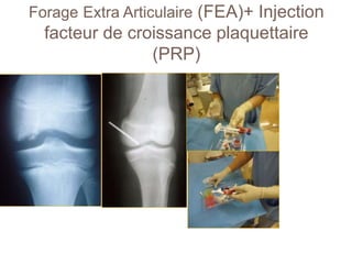 Forage Extra Articulaire (FEA)+ Injection 
facteur de croissance plaquettaire 
(PRP) 
 