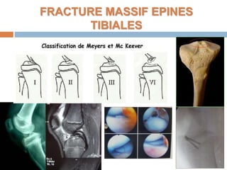 FRACTURE MASSIF EPINES 
TIBIALES 
 