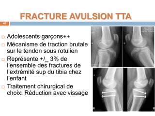 FRACTURE AVULSION TTA 
40 
 Adolescents garçons++ 
 Mécanisme de traction brutale 
sur le tendon sous rotulien 
 Représente +/_ 3% de 
l’ensemble des fractures de 
l’extrémité sup du tibia chez 
l’enfant 
 Traitement chirurgical de 
choix: Réduction avec vissage 
 