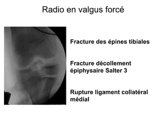 Radio en valgus forcé 
Fracture des épines tibiales 
Fracture décollement 
épiphysaire Salter 3 
Rupture ligament collatéral 
médial 
 