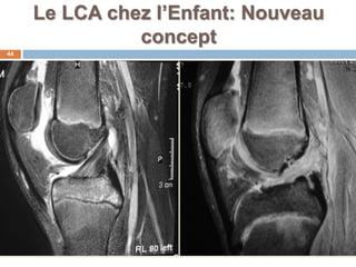 Le LCA chez l’Enfant: Nouveau 
concept 
44 
 