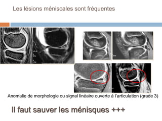 Les lésions méniscales sont fréquentes 
Hypersignal intra méniscal (grade 2) 
Anomalie de morphologie ou signal linéaire ouverte à l’articulation (grade 3) 
Il faut sauver les ménisques +++ 
 