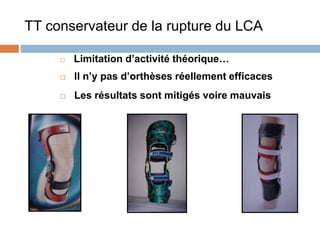 TT conservateur de la rupture du LCA 
 Limitation d’activité théorique… 
 Il n’y pas d’orthèses réellement efficaces 
 Les résultats sont mitigés voire mauvais 
 